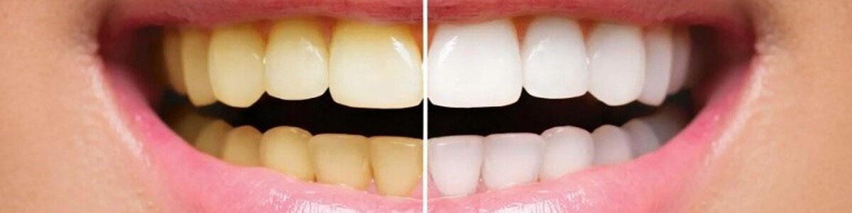 آیا پوست گردو دندان را سفید میکند؟