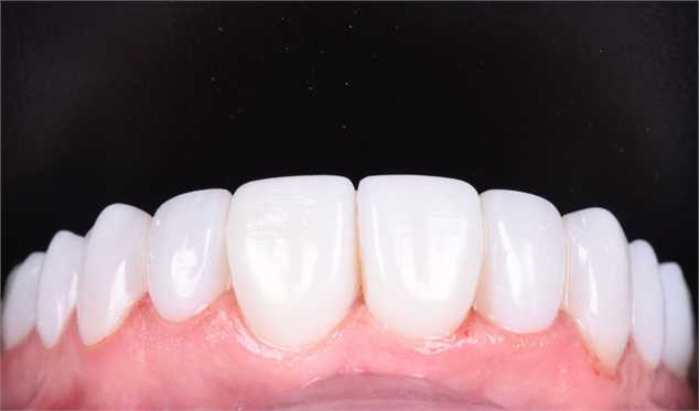 9 گام اساسی از مراحل کامپوزیت دندان چیست؟